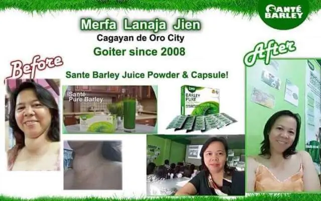 Sante Barley - Goiter Testimonial